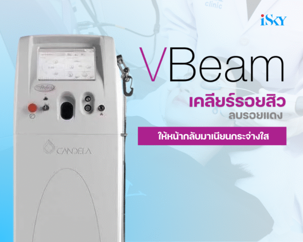 Program V-Beam Laser เคลียร์รอยสิว ลบรอยแดง ให้หน้ากลับมาเนียนกระจ่างใส