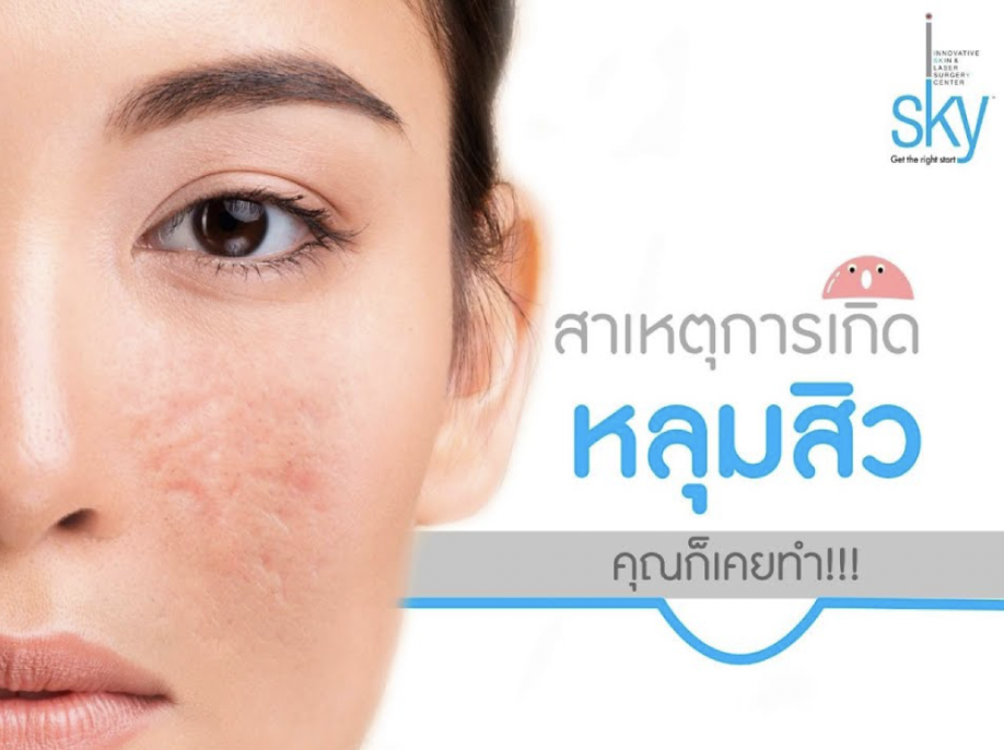 แผลหลุมสิวเกิดจากอะไร ?