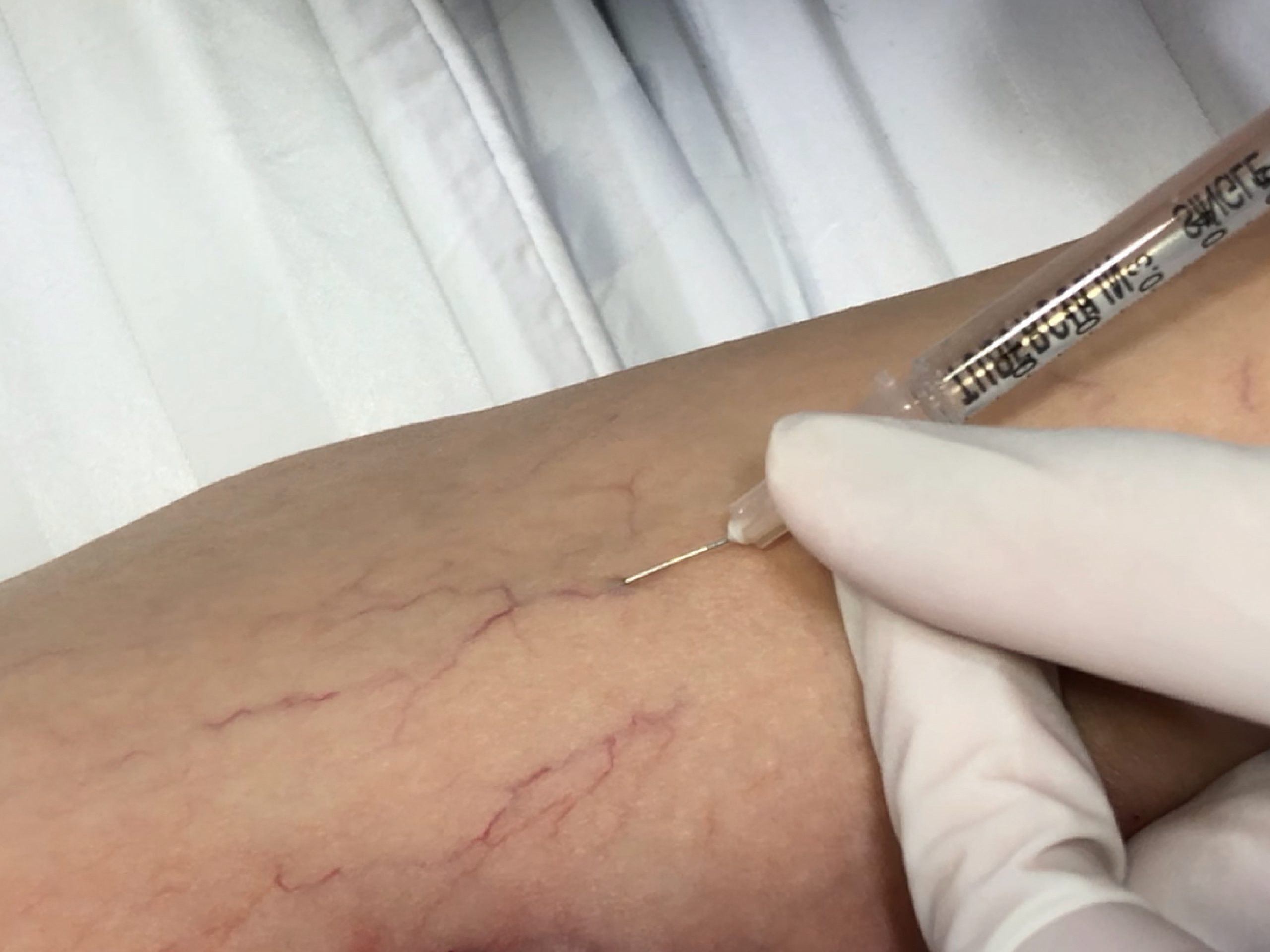 เส้นเลือดฝอยที่ขา