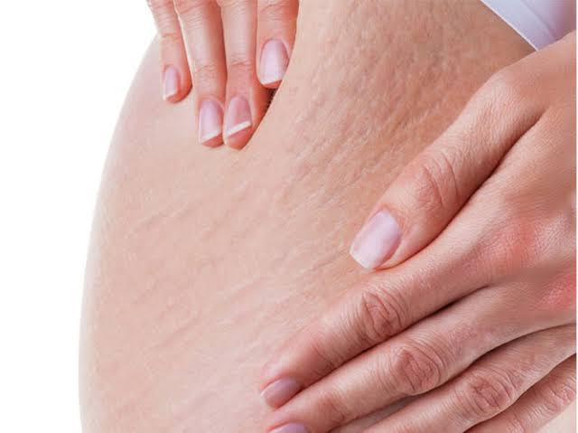 การรักษาท้องแตกลาย