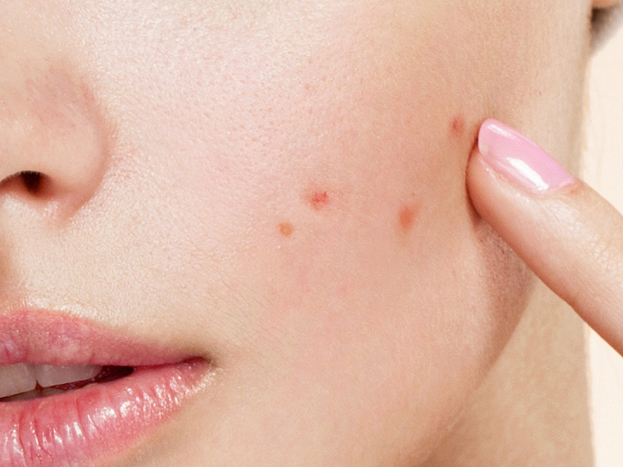 เรื่องสิวสิว