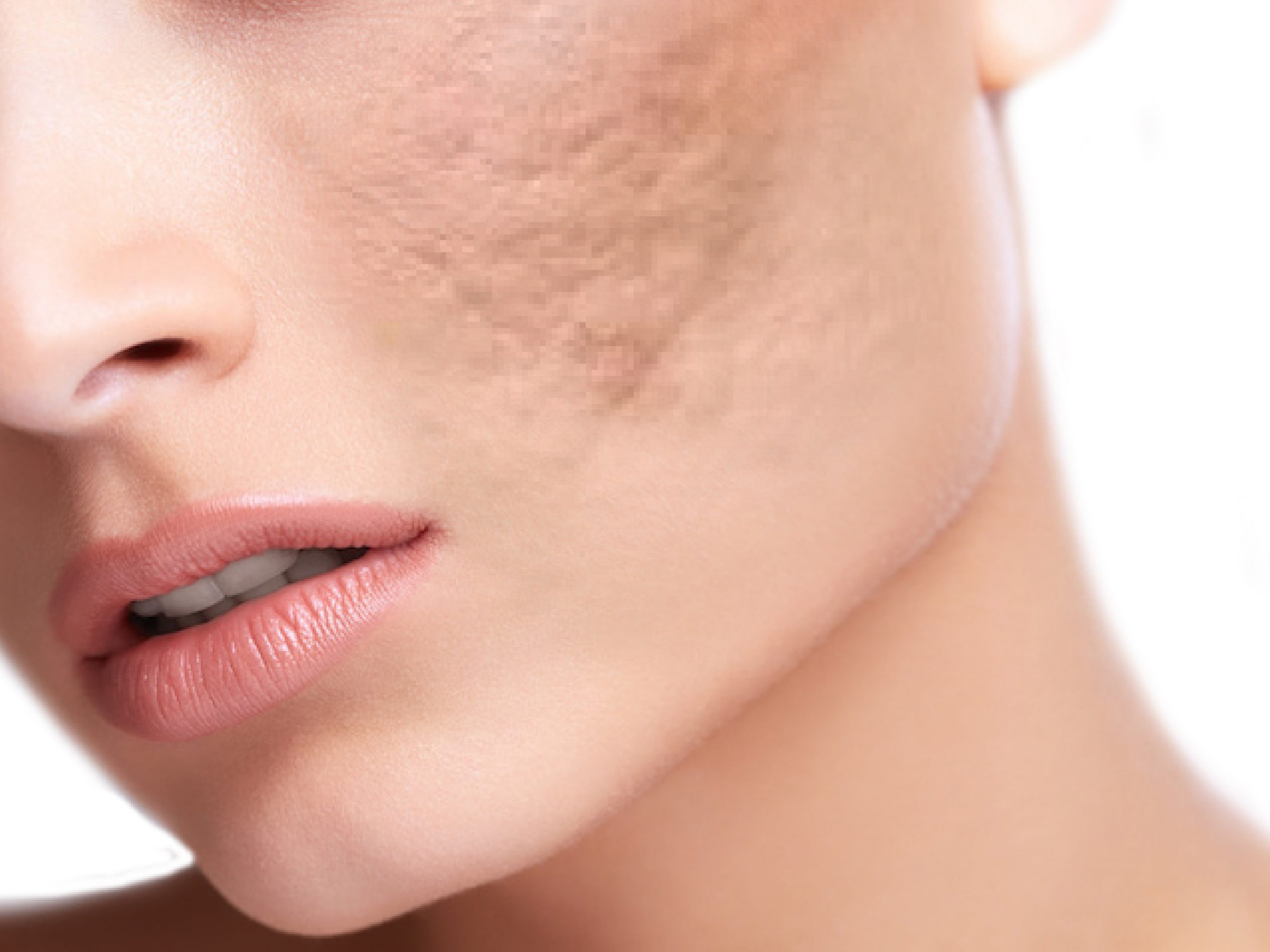 แผลหลุมสิวรักษาได้อย่างไร ?