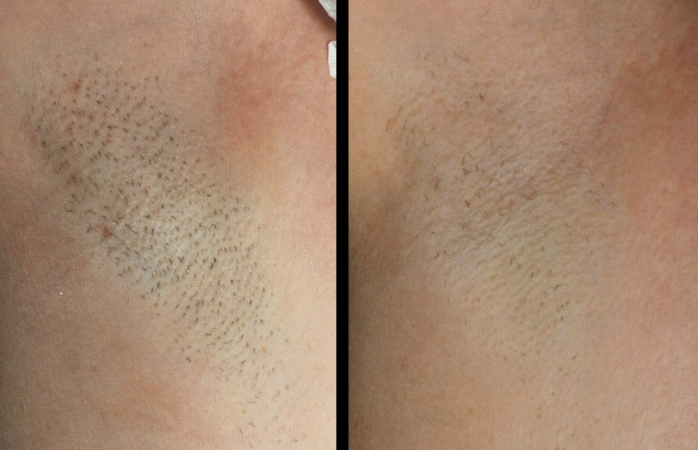 เลเซอร์กำจัดขน (Laser Hair Removal) คืนความเรียบเนียนสู่ผิวของสาว ๆ