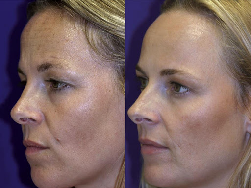 เจาะลึกผลลัพธ์สุดทึ่งของโบท็อกซ์ (Botulinum Toxin)