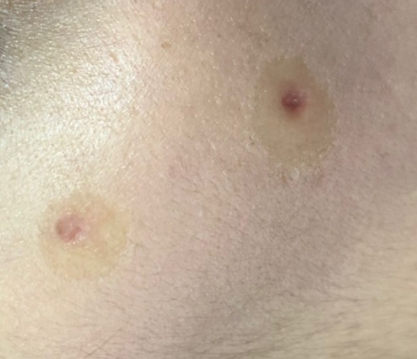 จี้ไฝอย่างไรไม่ให้เกิดแผลเป็น