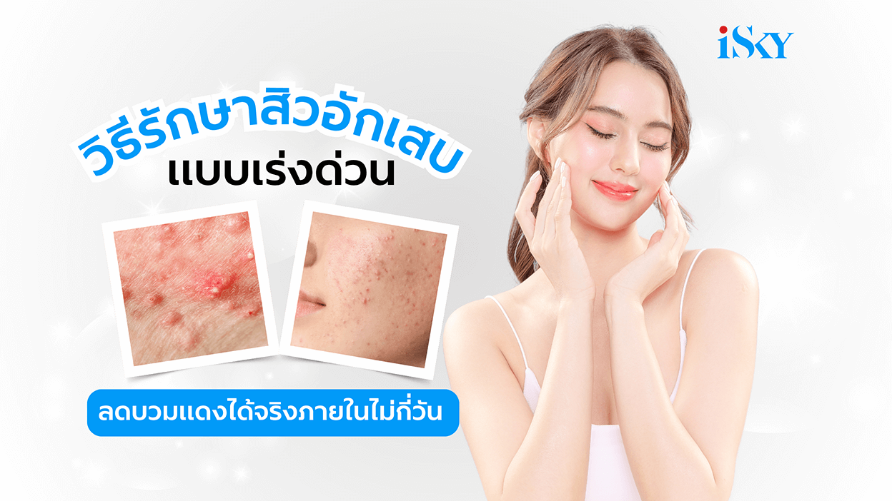 วิธีรักษาสิวอักเสบแบบเร่งด่วน ลดอาการบวมแดงได้ภายในไม่กี่วัน