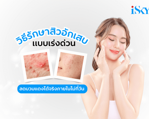 วิธีรักษาสิวอักเสบแบบเร่งด่วน ลดอาการบวมแดงได้ภายในไม่กี่วัน