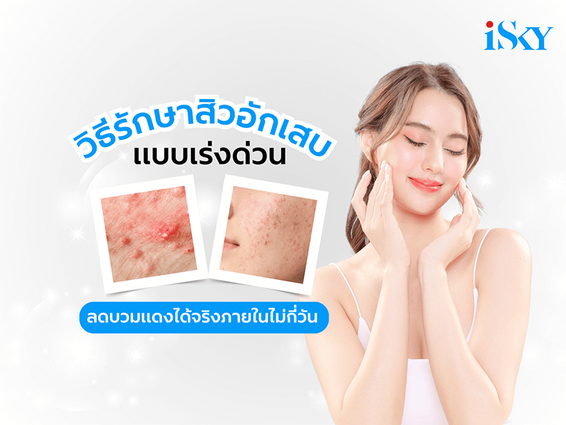 วิธีรักษาสิวอักเสบแบบเร่งด่วน ลดอาการบวมแดงได้ภายในไม่กี่วัน